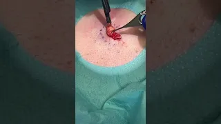 Dermal Piercing Removed! | 208SkinDoc