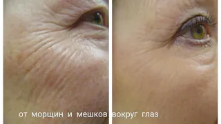 How to remove crow's feet, drooping eyelid and wrinkles around the eyes with your own hands at home?