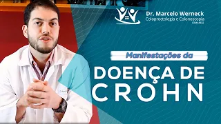 Sintomas  da doença de Crohn | Dr. Marcelo Werneck