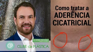 Clube da Plástica: como tratar a aderência cicatricial