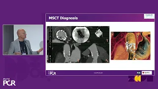 Identification and treatment of (sub)clinical transcatheter valve thrombosis - EuroPCR 2024