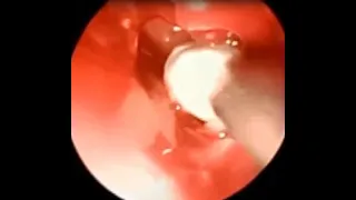 Fungus Ball in Sphenoid Sinus