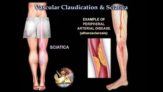Vascular Claudication or Sciatica - Everything You Need To Know - Dr. Nabil Ebraheim