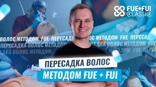 Вторая пересадка волос. Клиника пересадки волос FUE