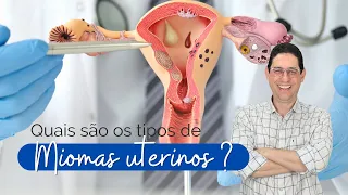 Quais são os tipos de miomas uterinos?