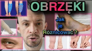 Obrzęki żylne, limfatyczne, tłuszczowe. Jak je rozpoznać? Jak je leczyć?