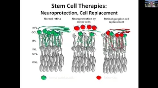 Regeneration and stem cell transplantation as treatment for optic neuropathies