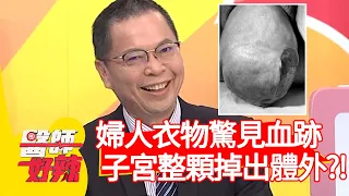 婦人衣物驚見血跡，子宮整顆掉出體外？！【@ebchellodoctor  】20201012 part2 EP1030 陳炳諴 劉涵竹