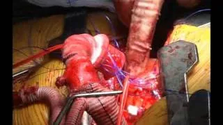 Aortic Valve Bypass Surgery: Beating Heart Therapy for Aortic Stenosis