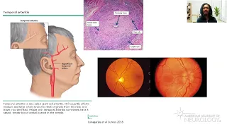 Virtual Resident Education Lecture Series: Headache Medicine - American Academy of Neurology