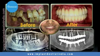 Dental Implants in Patients With Severe Bone Loss - Dr.Sudhakara Reddy | Bone Grafting Bangalore
