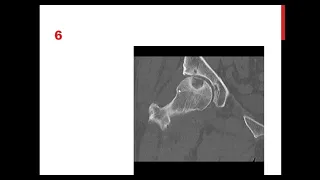 REVISION BONE  TUMORS Prof.Hesham Elsheikh