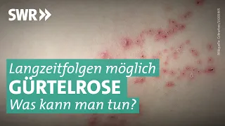 Gürtelrose oder Herpes zoster – wie wichtig ist die Impfung? | Marktcheck SWR