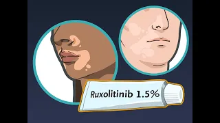 Ruxolitinib Cream for Vitiligo | NEJM