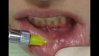Удаление ретенционной кисты нижней губы