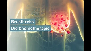 Brustkrebs: Die Chemotherapie