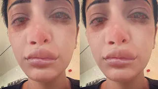 Shruti Haasan looks Unrecognizable after her Nose job and Lip Surgery gone Horribly Wrong!