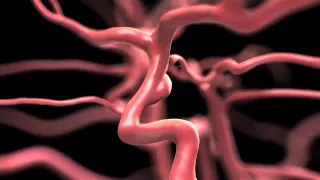 Aneurysm: Signs Symptoms Risks and Treatments Explained By Memorial Neuroscience Institute