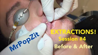 Severe Acne extractions. Session 4, amazing before and after! So many pops!