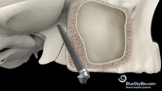 Pterygoid Implant placement