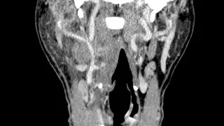 HN C1 Tonsillar abscess B (Ahuja AT et al; 2017) Book: Essential Radiology ...