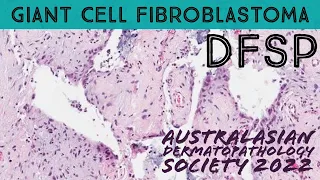 Giant cell fibroblastoma (pediatric variant of dermatofibrosarcoma protuberans DFSP) pathology