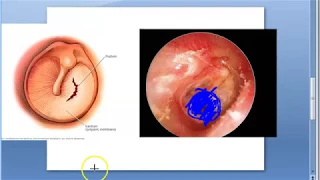 ENT Ear Tympanic Membrane Perforation Trauma Injury Hit Hurt Causes Repair Treatment
