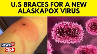 Alaskapox | New Virus Sparks Scare In US | Explained: What Is Alaskapox? | N18V