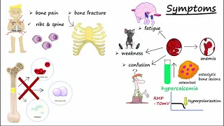 Multiple Myeloma