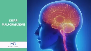 Chiari Malformations Types, Diagnosis and Treatment