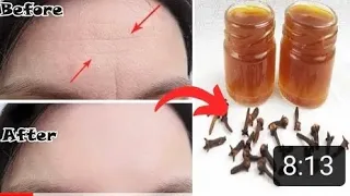 Mix cloves with water and look 10 years younger than your age ~ natural BOTOX