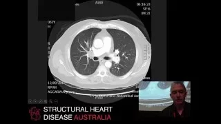 ECMO for massive pulmonary embolism - Prof Paul Forrest