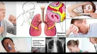 Симптомы пневмонии / Здравствуйте