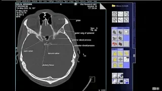 how to read ct scan of  Skull bony window With Text