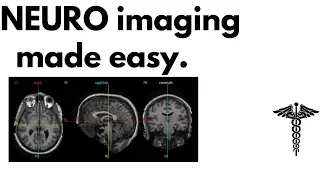 Neuroanatomy on MRI | Part 1| Cerebrum, Basal Ganglia, Thalamus, Internal Capsule & Lesions