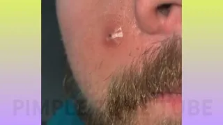 "Watch in Amazement: Extreme Blackhead Removal Compilation" PART 1