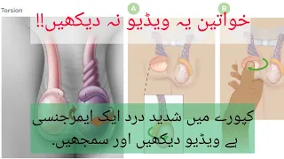 Kaporay ka phool jana (Testicular torsion)