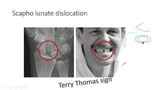 FOREARM fracture ,WRIST fracture PART -2