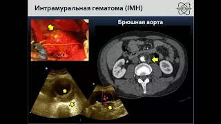 Андрейчук К.А. «Неотложная ультразвуковая диагностика острого аортального синдрома»