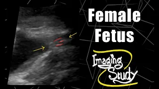 Female Fetus || Ultrasound || Case 57