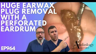 HUGE EAR WAX PLUG REMOVAL WITH A PERFORATED EARDRUM - EP964