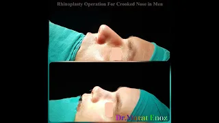 Rhinoplasty Operation For Crooked Nose
