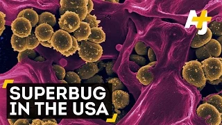 Antibiotic-Resistant Superbug Found In The U.S.