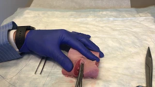 2nd Degree Vaginal Laceration Repair