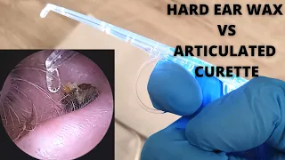 Hard Ear Wax VS Articulating Curette