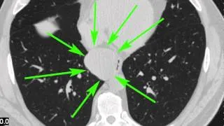 Oesophageal Large Mass mimicking Leiomyoma (bronchogenic cyst of the mediastinum)