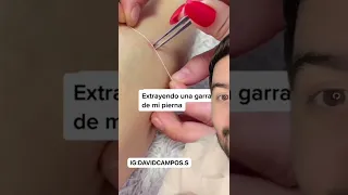 ASI RETIRAN UNA GARRAPATA