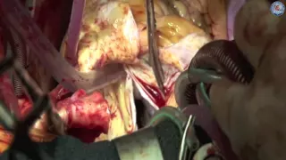 Aortic root and total arch replacement with frozen elephant trunk procedure