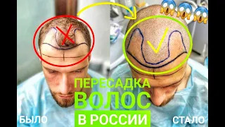 Пересадка волос в России. Блог #1