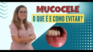 O que é e como evitar a mucocele? | Adornare Odontologia Estética em Santos